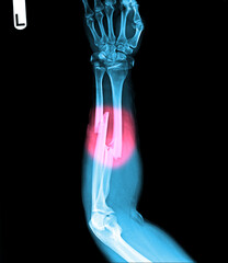 film X-ray fracture forearm in red dot