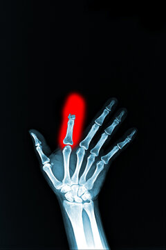 film x-ray facture finger in red area