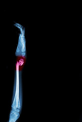 Film x-ray AP fracture both bone of forearm.