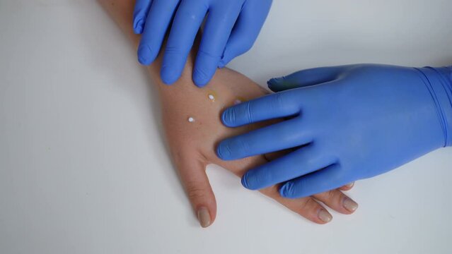 Top view female hand with doctor in gloves analyzing monkey pox rash in slow motion. Close-up unrecognizable physician consulting ill Caucasian young woman with monkeypox