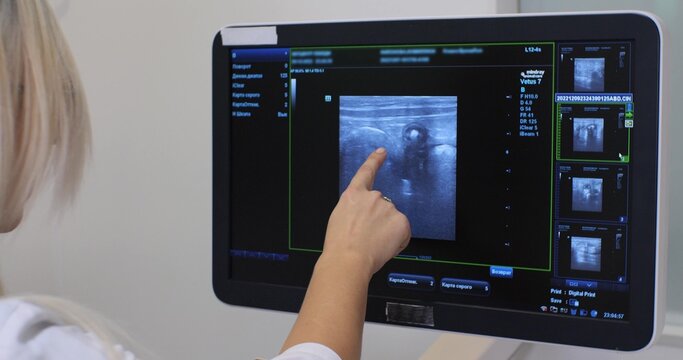 A woman doctor runs her finger over the picture on the ultrasound machine's manitour, studying the results of the study. The doctor examines the place of the pathology in the ultrasound picture.