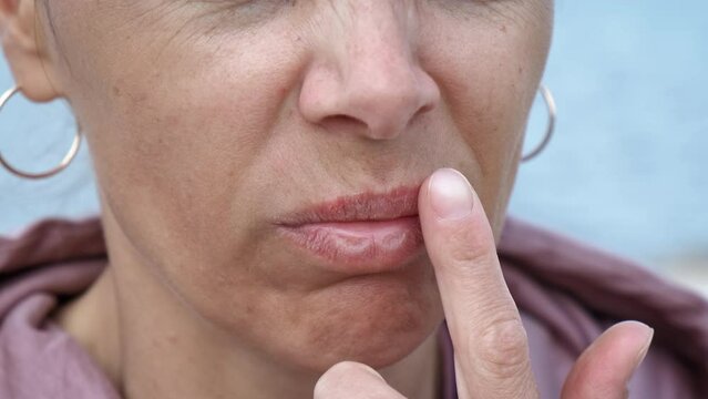 Herpes. Woman touches chapped lips with herpes.