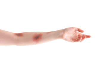 Fototapeta premium Bruised female hand on white background