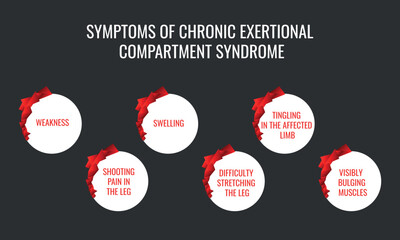 symptoms of Chronic exertional compartment syndrome. Vector illustration for medical journal or brochure.
