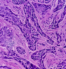 Basal cell carcinoma, show skin, malignant neoplasm of atypical basaloid cells with peripheral palisading, Cheek tissue cancer.