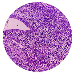 Uterus wall consist pyometra with cervicitis, photomicrograph show dense infiltration of...