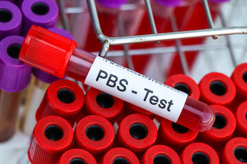 PBS test to look for abnormalities from blood