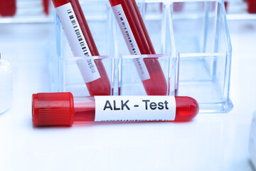 ALK test to look for abnormalities from blood