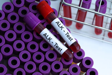 ALK test to look for abnormalities from blood