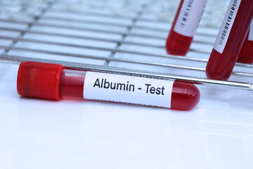 Albumin test to look for abnormalities from blood
