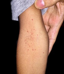 Red spots in cubital fossa. Hess’s test positive. Dengue hemorrhagic fever.