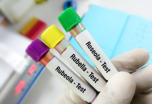 Scientist Holding Blood Samples For Rubeola (measles), Rubella (German Measles) And Roseola (Exanthem Subitum) Test.