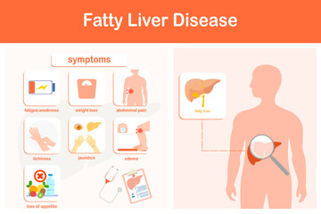 Vector illustration. Infographic of fatty liver disease.  Weakness, jaundice, edema, pain in the right side of the abdomen, decreased appetite, and rapid weight loss. - obrazy, fototapety, plakaty