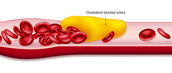 Cholesterol in blood vessels. Atherosclerosis. Clogged arteries caused by cholesterol.