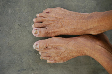 picture of a pair of  asian old men's feet with unkempt nails, top view 