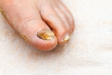 Fungus Infection on Nails of Man's Foot.Nail disease.Nail fungus on legs.Closeup shot.