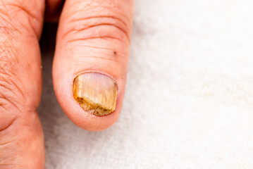 Nail fungus infection on the thumb finger.Fungal infection on nail hand,finger with onychomycosis,damage on human hand.Closeup.Copy space. - obrazy, fototapety, plakaty