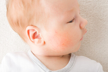 Newborn boy cheek with red rash. Allergy from milk formula or mother milk. Baby skin problem. Closeup. Top down view.