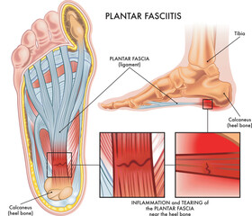 Medical illustration showing section of foot with symptoms of plantar fasciitis with two magnified details of affected points, and annotations.