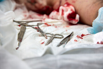 Metal surgical instruments lie in the blood near the human body after surgery on the operating...