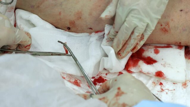 With help surgical clamps, doctor removes varicose node from hole in patient's leg remove, assistant wipes blood with gauze wipes. Process of removing the affected part of the vein in varicose veins