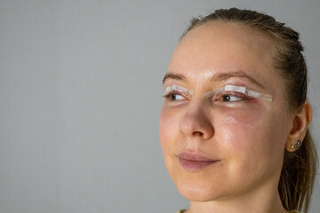 woman face after plastic surgery, blepharoplasty operation, swelling eye bags, incisions with...