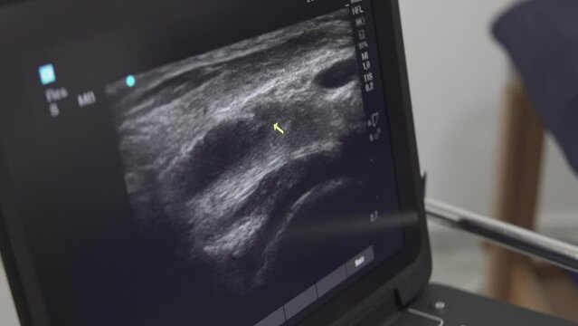 doctor pointing out the problematic area using a mouse cursor in a live sonogram on a monitor using an ultrasonography diagnostic machine in a physiotherapy clinic, closeup