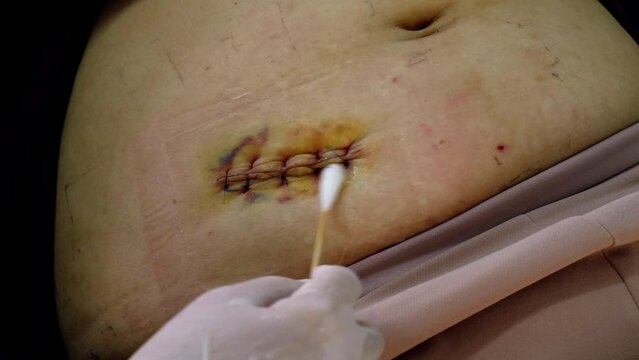 wash the wound,A woman shows an appendicitis scar on his stomach, a scar from an appendicitis operation on his stomach. appendectomy.wash the wound.Medicine concept