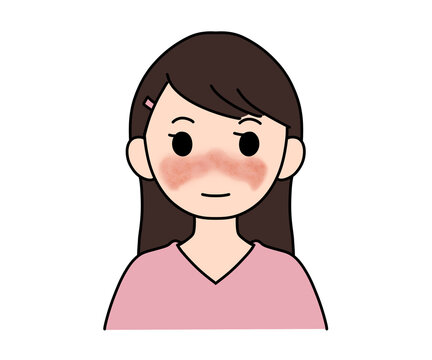 顔の紅斑