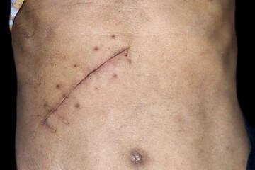 Scar of Kocher’s incision at the abdomen. Top view.