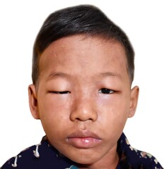 Angioedema at eyelids and lips of Southeast Asian child. Edematous child. Caused by drug, seafood...