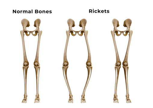 Rickets is a metabolic disease characterized by deformities of the bones. The most common symptoms are bowed legs
