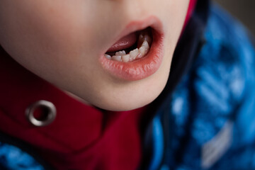 A permanent tooth in a child.
