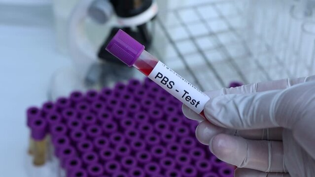 PBS test to look for abnormalities from blood,  blood sample to analyze in the laboratory, blood in test tube
