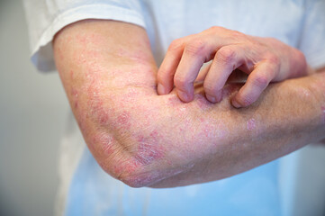 Itchy psoriasis on arm and hand - obrazy, fototapety, plakaty