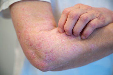Itchy psoriasis on arm and hand