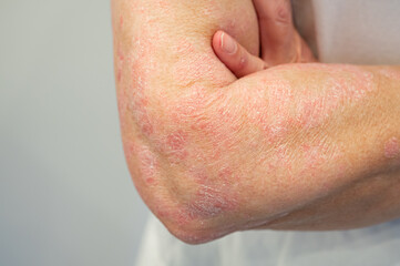 Skin disease psoriasis on arm and hand