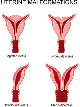 uterine malformations