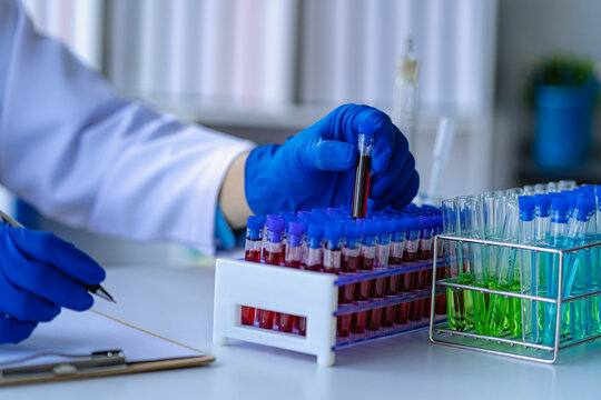 Professional Doctor Examining Arterial Blood Sample, Professional Research In Nurse With Microscope Close Up Of Blood Test Tube Held By Female Lab Assistant In Lab Office