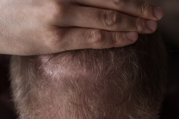 Naklejka premium Men hair loss problem alopecia