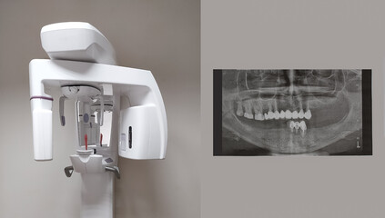 Modern dental digital 3D tomograph