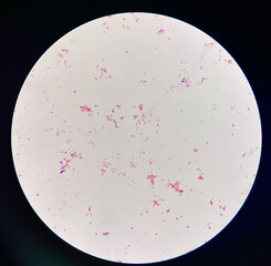 Gram negative diplococci in urine.