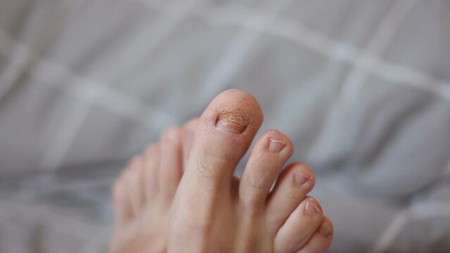 Male big toe nail has been removed. Damaged big toe from impact. Man with bare feet on the bed.	
