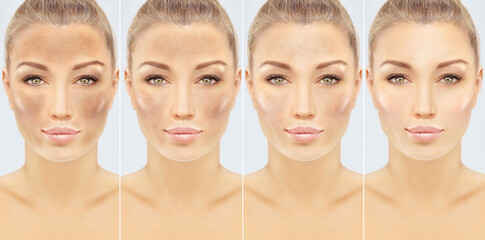 Dark spots, freckles,hyperpigmentation(melasma or chloasma),concept - skin lightening, skin...