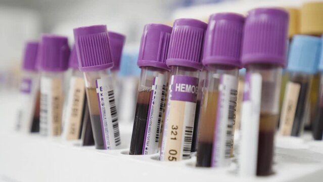 close up of purple urine blood sample plastic tubes in clinic hospital lab for analysis and test 