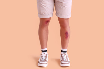 Man with bruises on legs against beige background - obrazy, fototapety, plakaty
