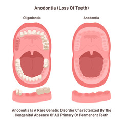 Anodontia. Rare genetic disorder characterized by the congenital - obrazy, fototapety, plakaty