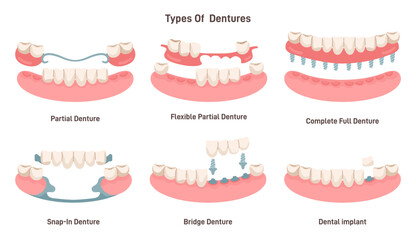 Dental prosthesis types set. Dental implant, partial, snap-in, bridge - obrazy, fototapety, plakaty