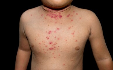 Molluscum contagiosum skin lesions also called water warts of Asian child.