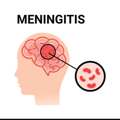 Meningitis inflammation of the brain, vector simple